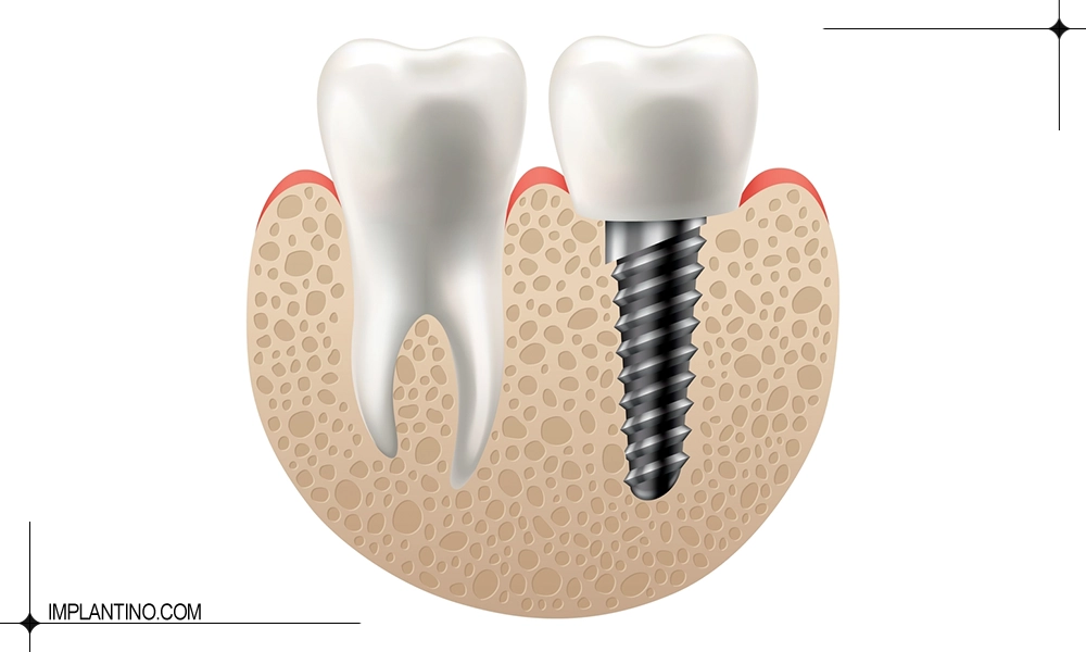 جدیدترین متد کاشت دندان