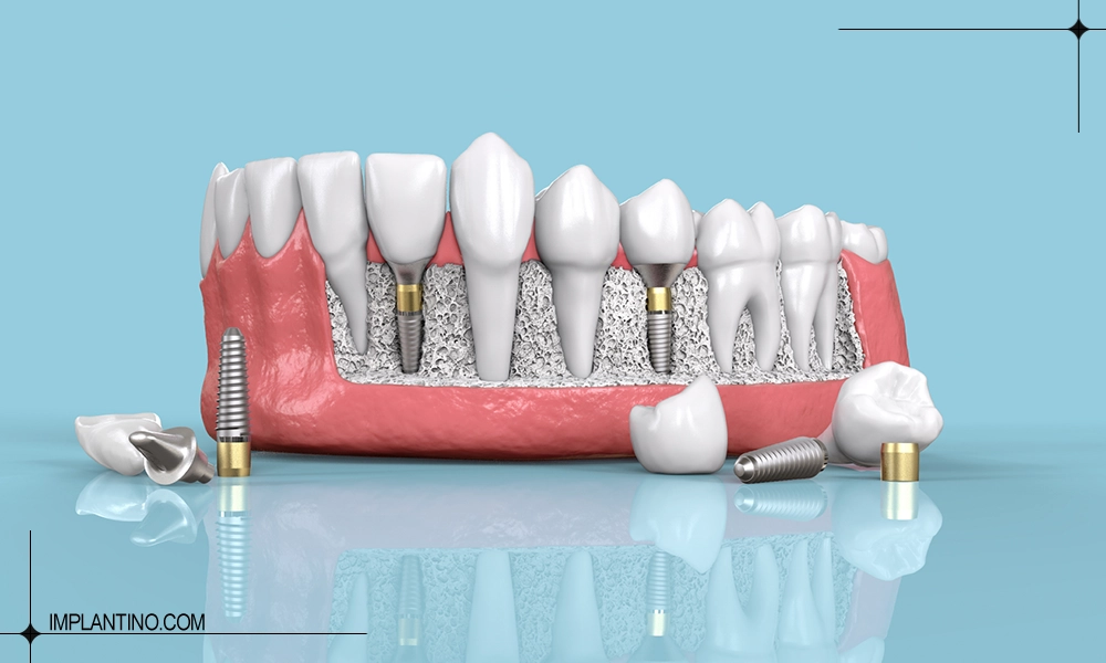 ایمپلنت کره ای یا سوئیسی را برای کاشت دندان انتخاب کنیم؟ 2 ایمپلنت کره ای و سوئیسی