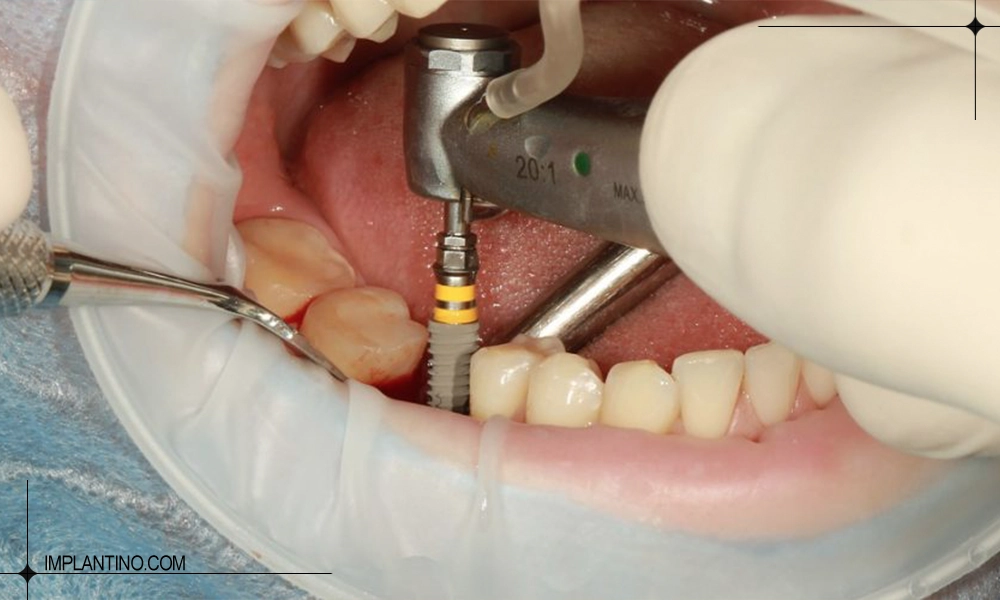 حرف زدن بعد از جراحی ایمپلنت چگونه خواهد بود؟ 2 قرار دادن ایمپلنت | حرف زدن بعد از جراحی ایمپلنت