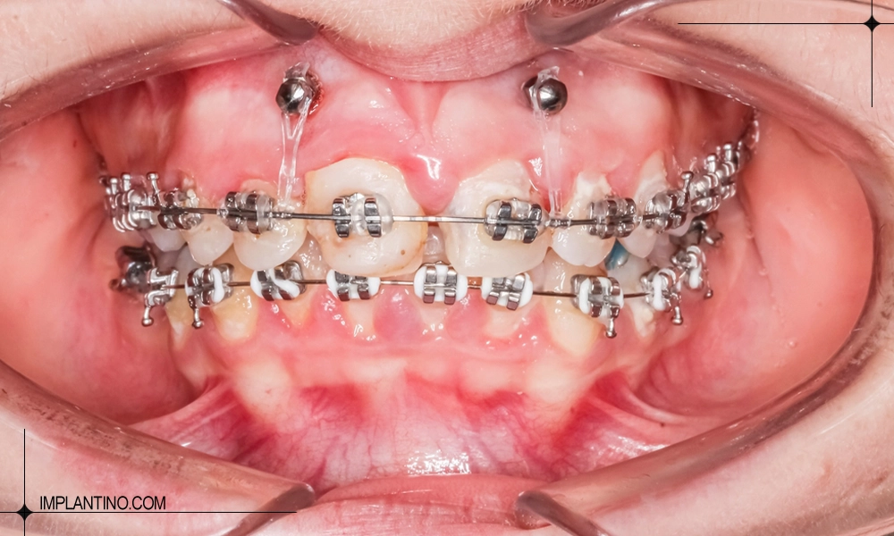 گوشت اضافه لثه بعد ار ارتودنسی