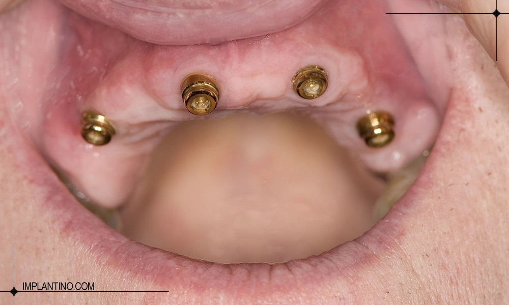 تعداد ایمپلنت برای فک بالایی