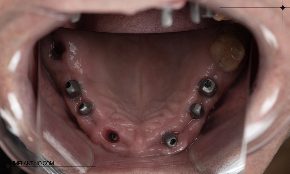 تعداد ایمپلنت برای فک پایین