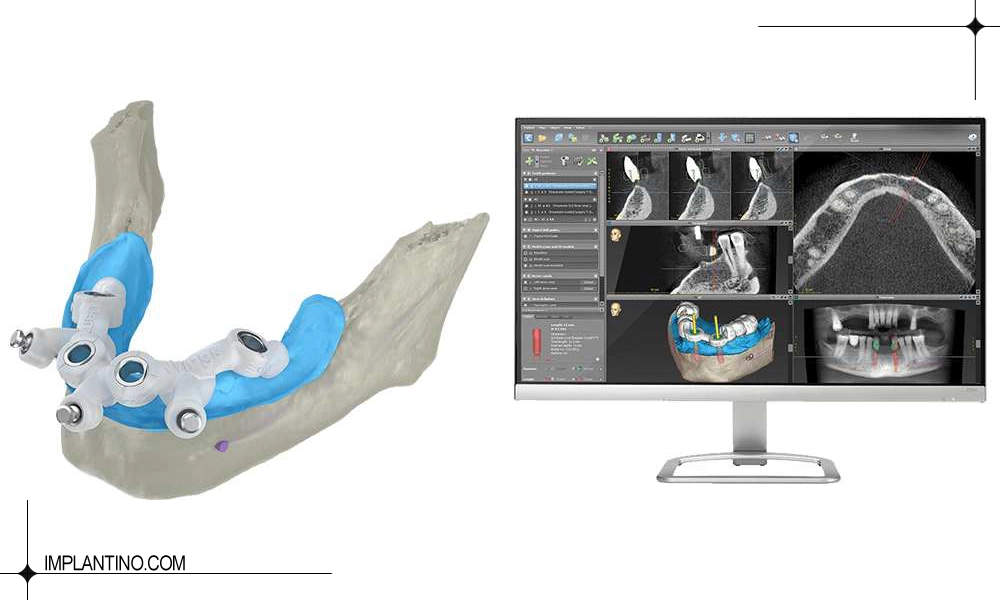 بهترین دندانپزشک ایمپلنت دیجیتال در تهران کیست؟ 2 شکل اسکن و ایمپلنت دیجیتال | بهترین دندانپزشک ایمپلنت دیجیتال در تهران