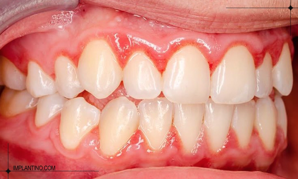 گوشت اضافه لثه بعد از درمان