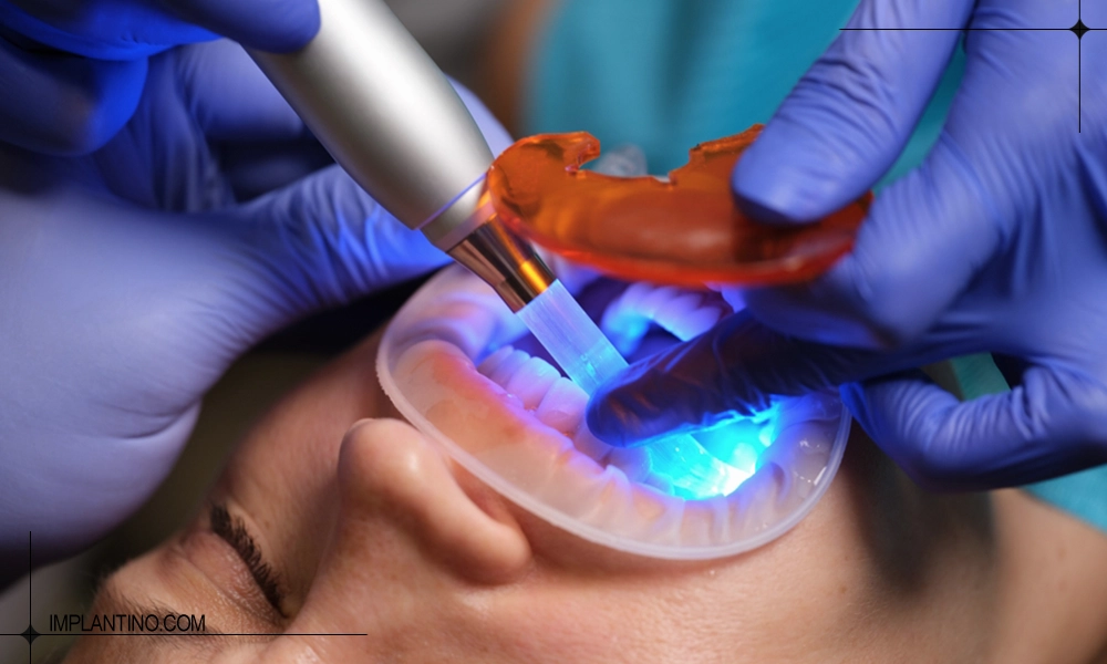 سفت کردن کامپوزیت با نور در مراحل کامپوزیت دندان