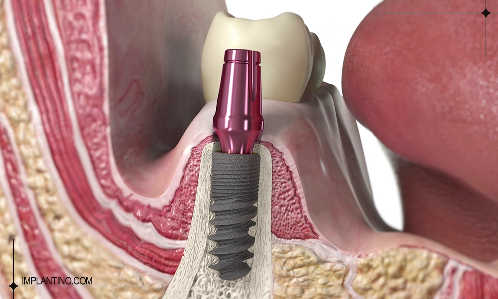 بهترین روش ایمپلنت
