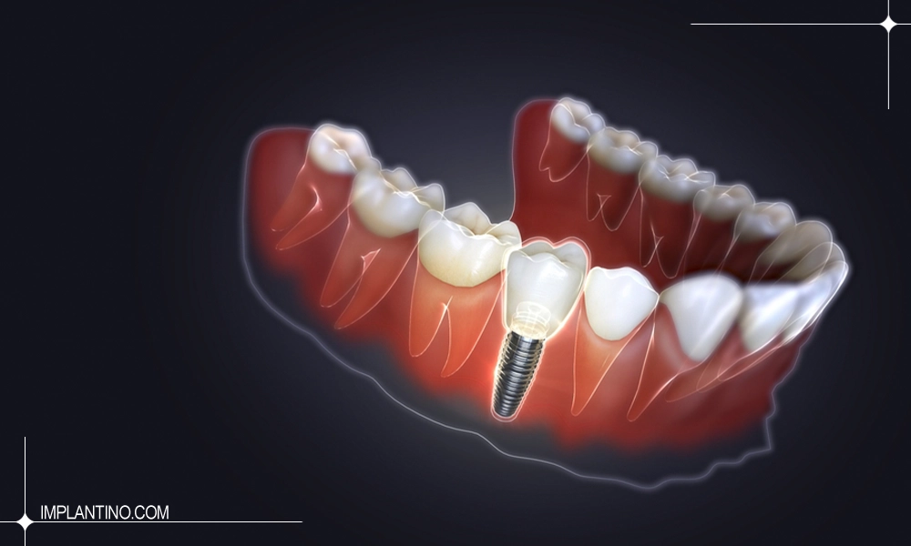 معرفی جدیدترین متد کاشت دندان