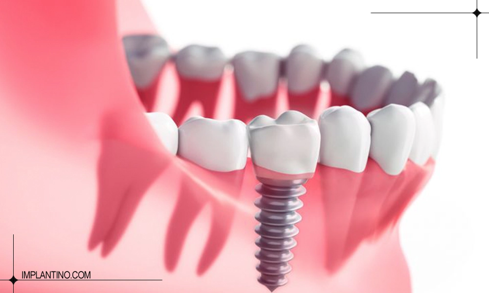 معرفی بهترین مرکز ایمپلنت در پاسداران 1 دندان کاشته شده در بهترین مرکز ایمپلنت در پاسداران