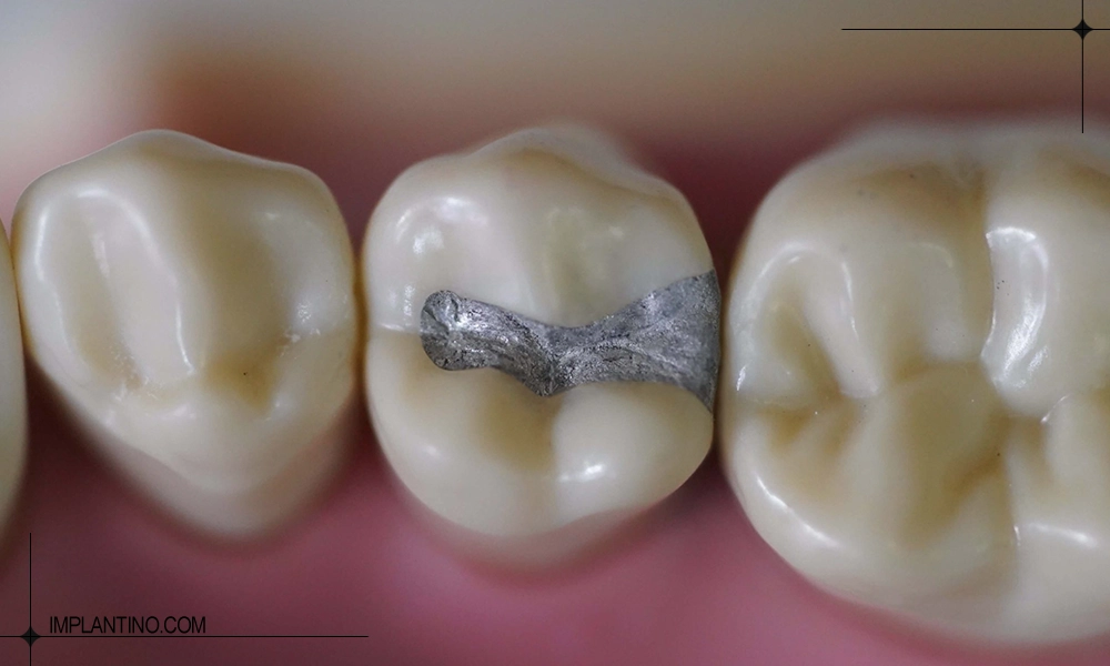 عکس تکمیل شده ترمیم دندان نزدیک به عصب