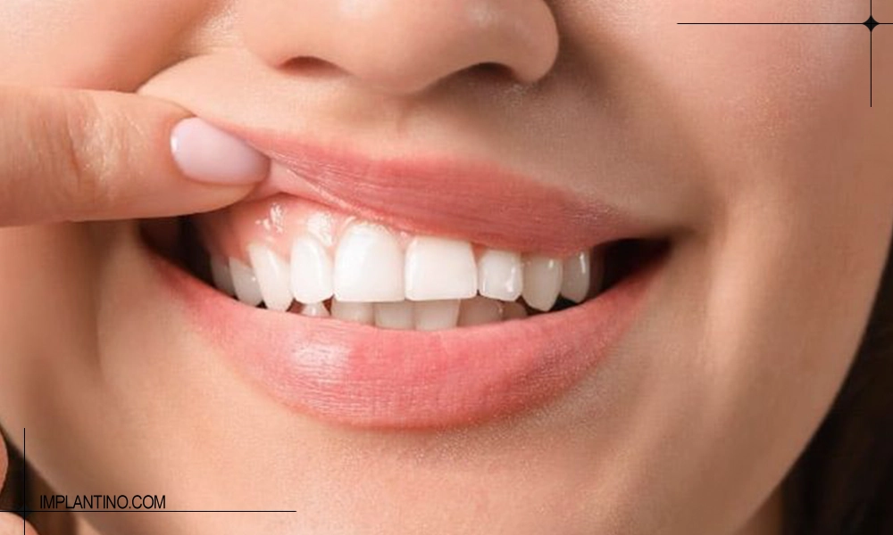 دلیل التهاب لثه بعد از کامپوزیت 2 التهاب لثه بعد از کامپوزیت