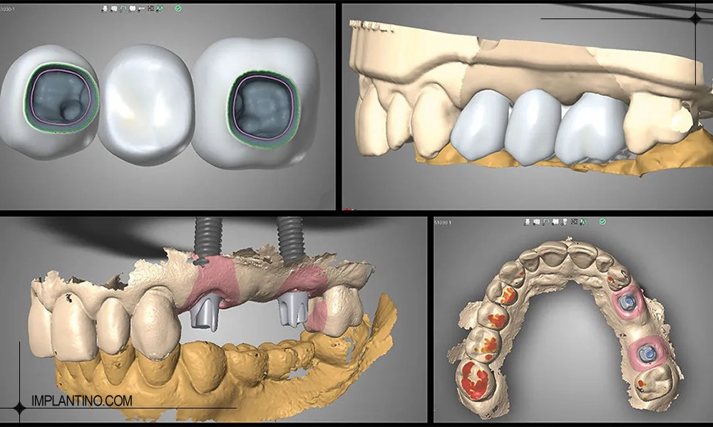 بهترین دندانپزشک ایمپلنت دیجیتال در تهران کیست؟ 1 نمونه ای از کاشت دیجیتال با بهترین دندانپزشک ایمپلنت دیجیتال در تهران