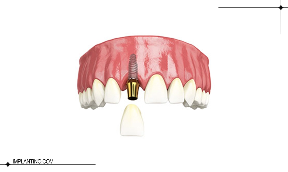 ایمپلنت فک بالا و تاج آن