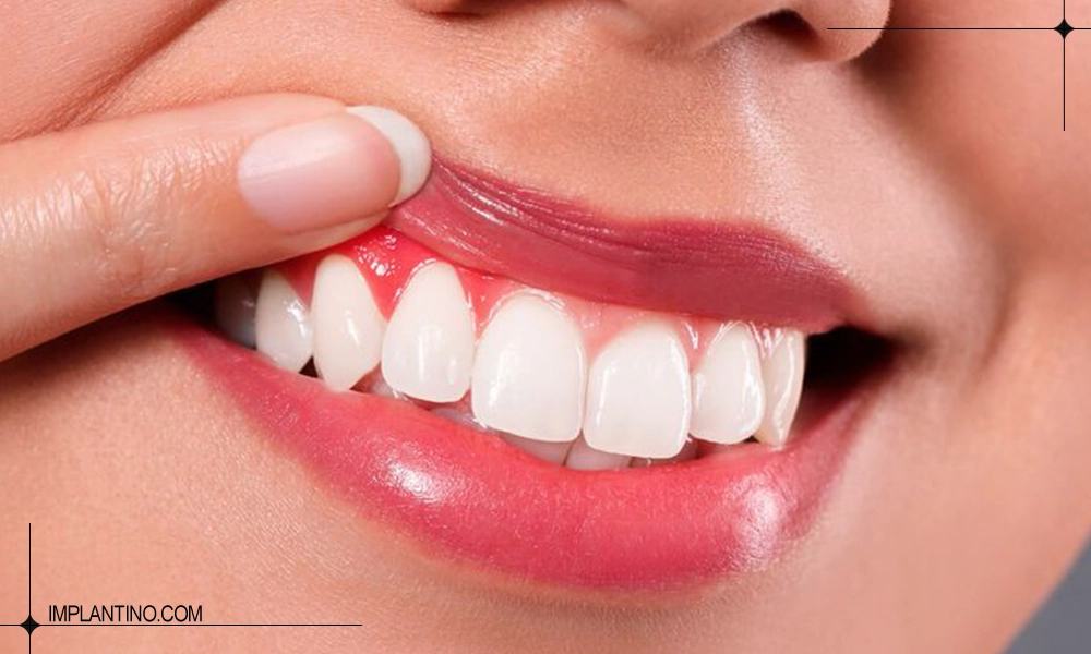 دلیل التهاب لثه بعد از کامپوزیت 1 عکس التهاب لثه بعد از کامپوزیت