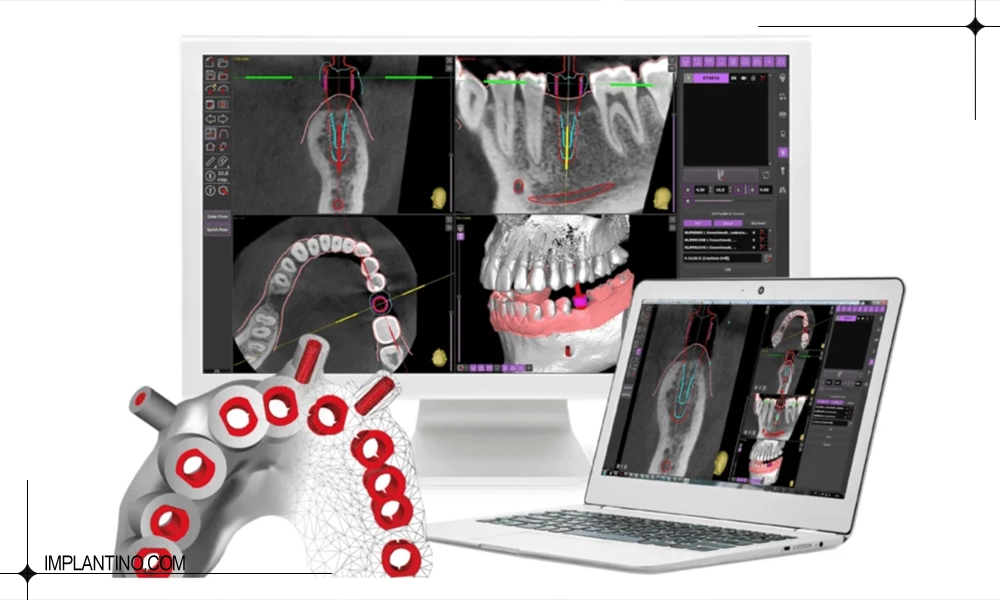 بررسی تفاوت ایمپلنت دیجیتال و معمولی از هر نظر 1 ایمپلنت دیجیتال و معمولی را چگونه انتخاب کنیم؟