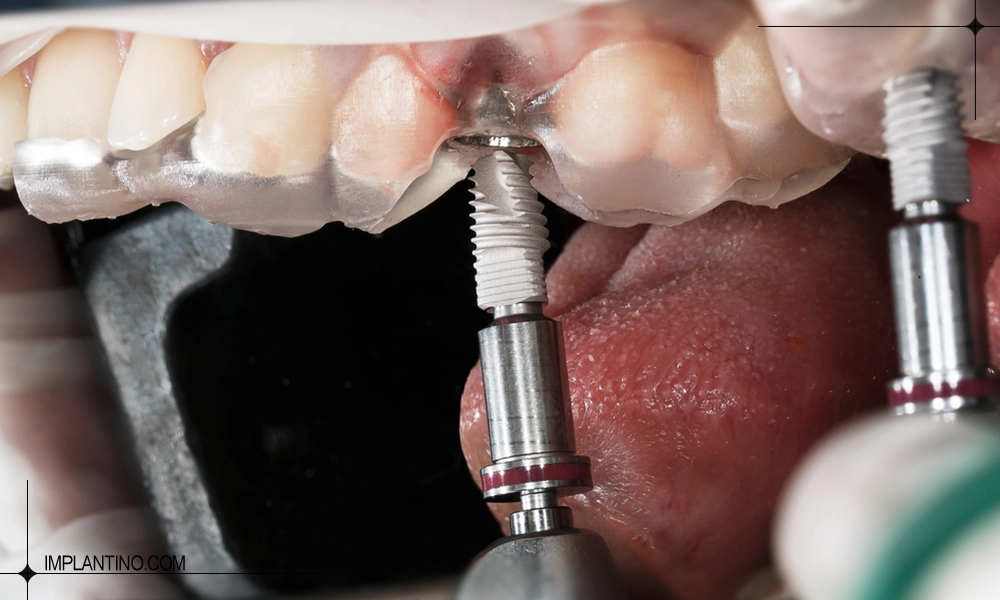 جایگزینی دندان ها با جدیدترین متد کاشت دندان