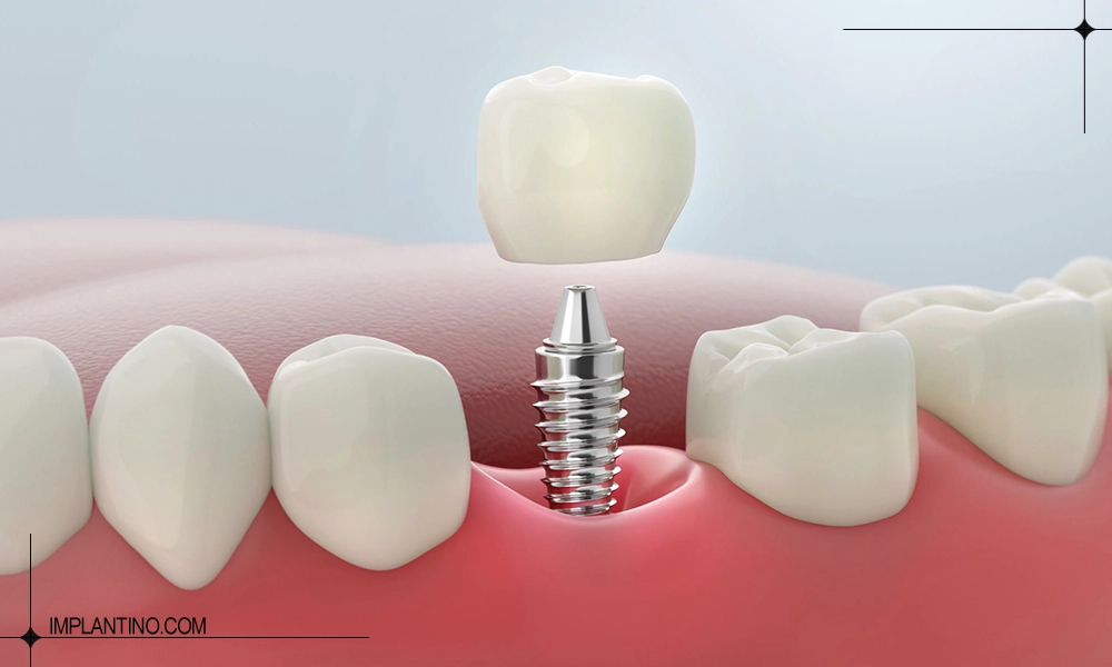 ایمپلنت بدون جراحی