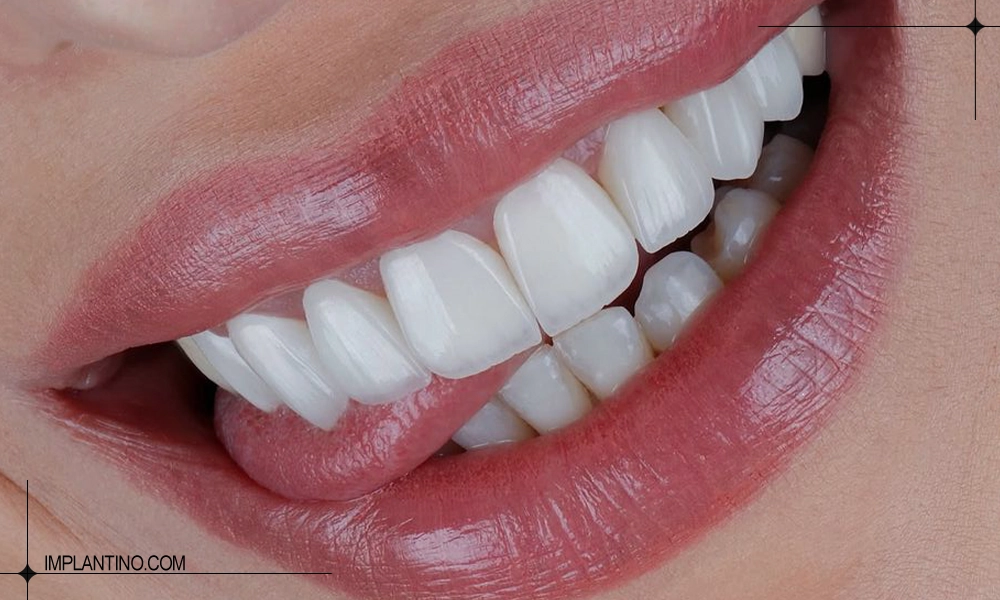 آشنایی با مراحل کامپوزیت دندان