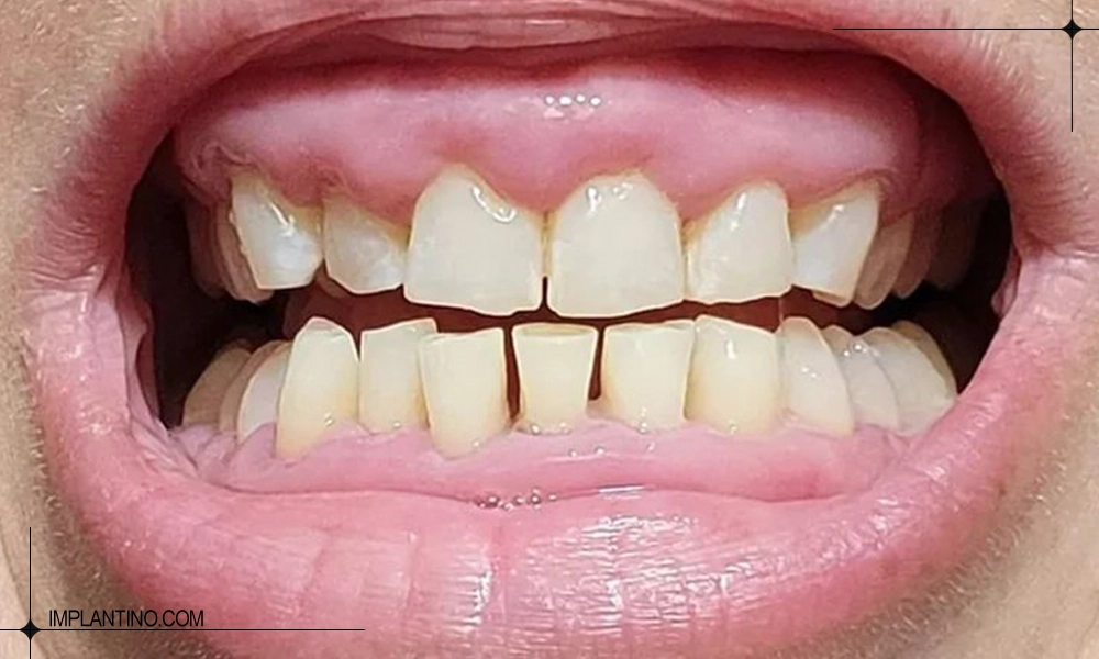 عکس گوشت اضافه لثه