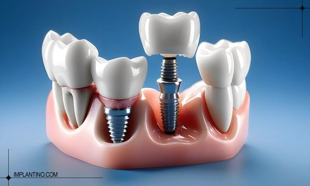 کاشت دندان در بهترین مرکز ایمپلنت در پاسداران