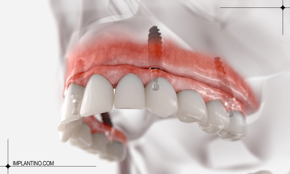 قرار دادن ایمپلنت فک بالا