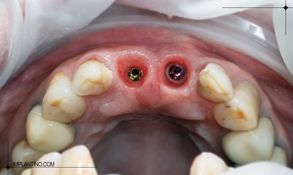 تعداد ایمپلنت برای فک بالا دندان های جلو
