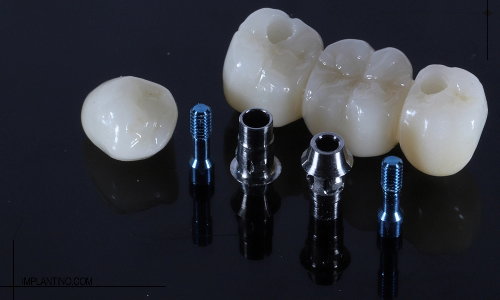 عکس خوب بودن ایمپلنت دندان