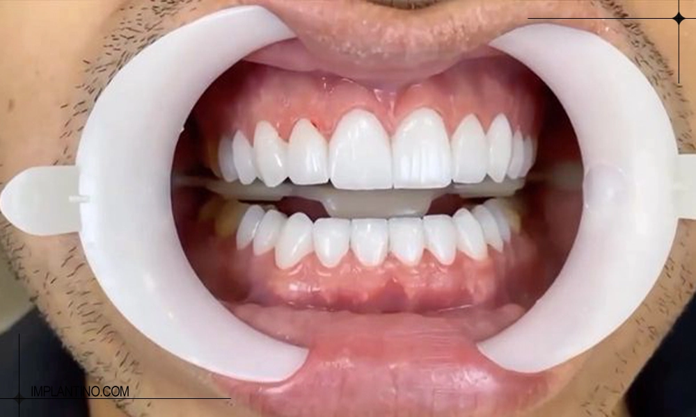 یکی از انواع کامپوزیت های دندان کار شده