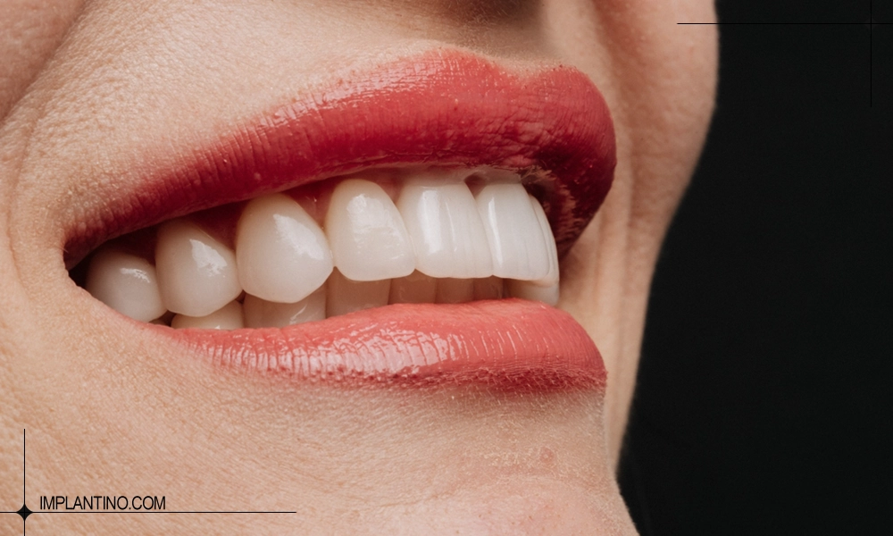 روند جوش خوردن ایمپلنت دندان چگونه خواهد بود؟ 1 عکس جوش خوردن ایمپلنت دندان جلو