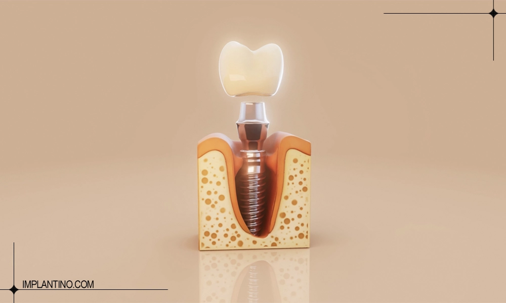 درد ایمپلنت چقدر است؟