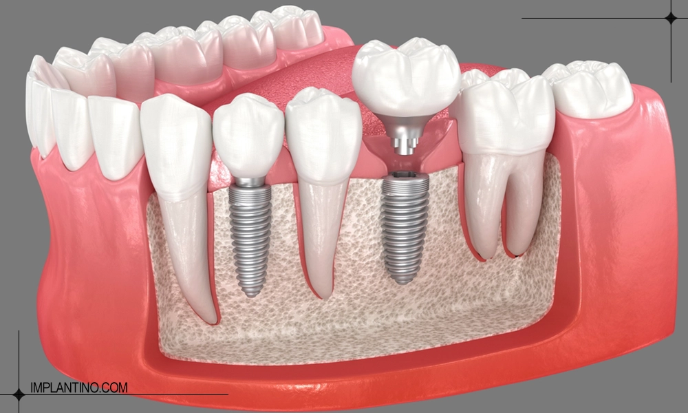 درد ایمپلنت دندان هنگام کاشت
