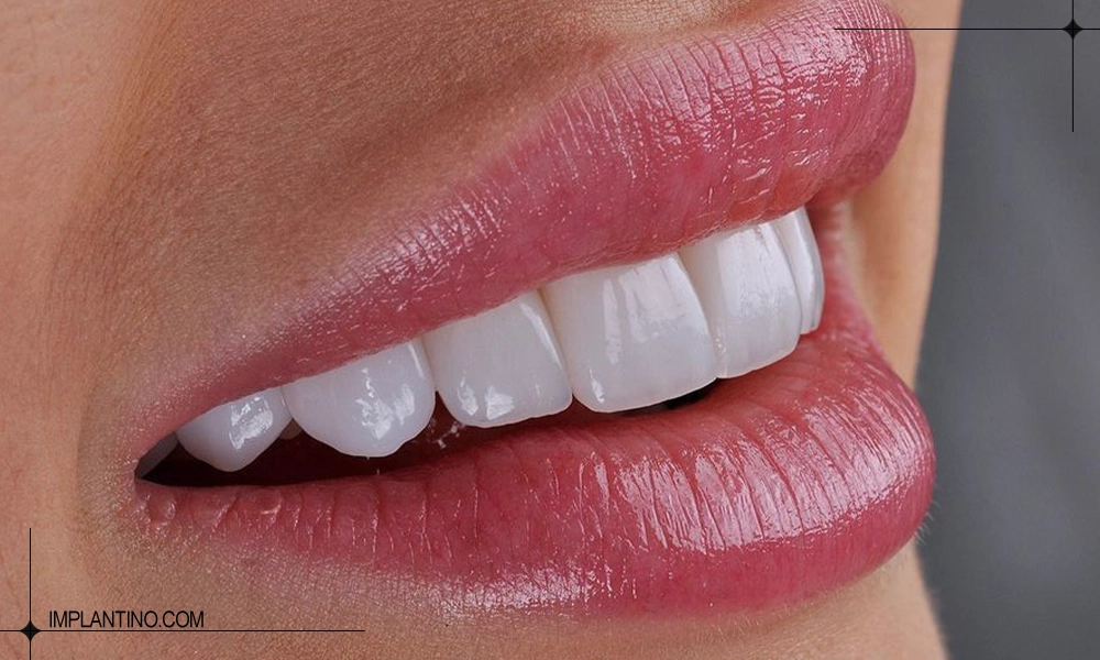 کامپوزیت دندان برای خانم | حرف زدن بعد از کامپوزیت دندان