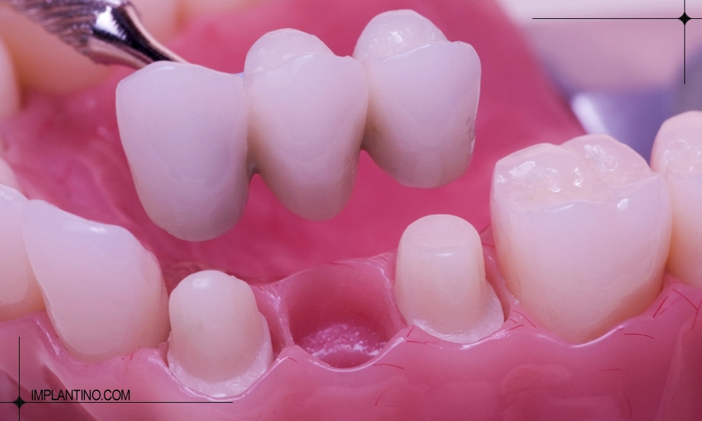 آشنایی با بریج یا پل دندان 3 پل دندان