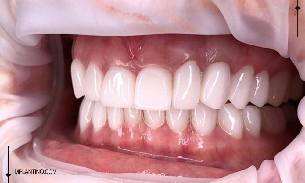 اتمام کار کامپوزیت و حرف زدن بعد از کامپوزیت دندان