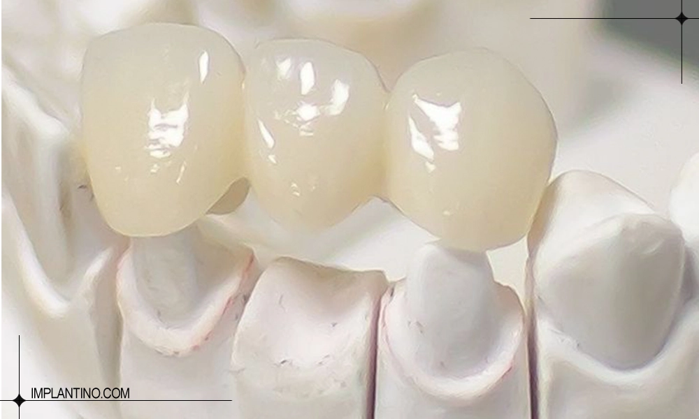 آشنایی با بریج یا پل دندان 2 پل دندان روی قالب دندان