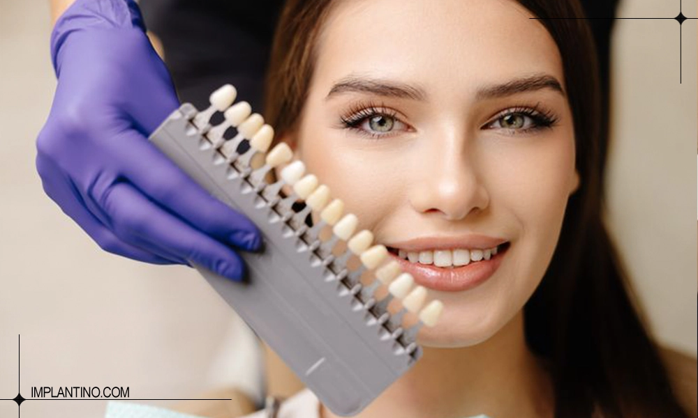 انواع کامپوزیت از نظر رنگ و روشنایی