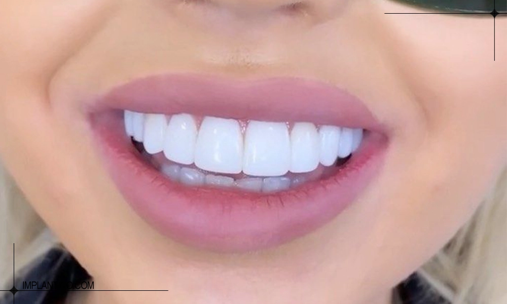 کامپوزیت دندان های جلو در انواع کامپوزیت دندان