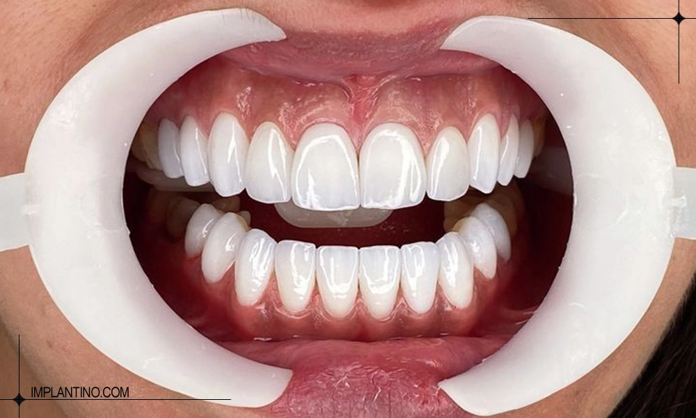 انتهای کار کامپوزیت در انواع کامپوزیت دندان