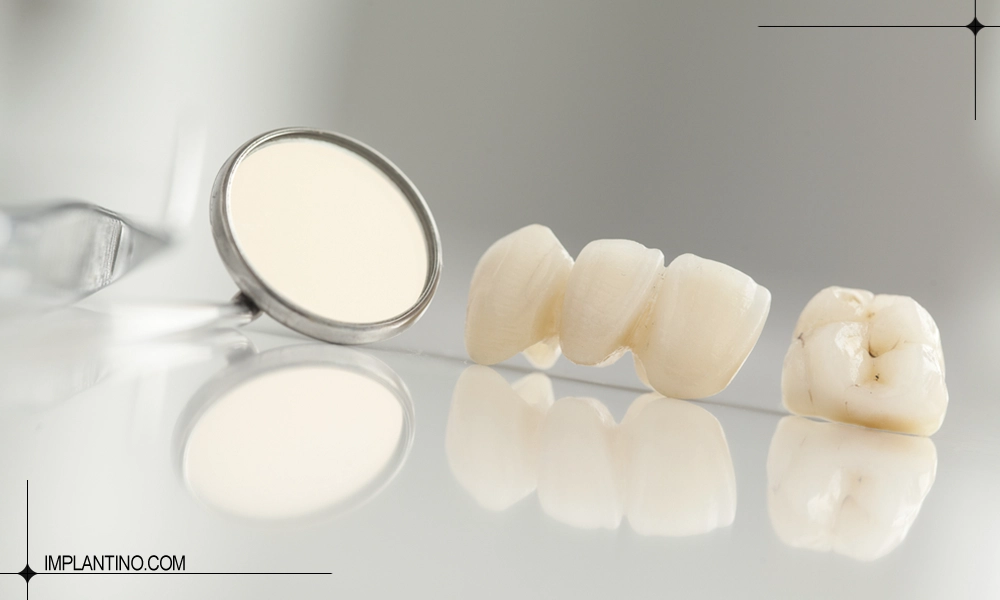 آشنایی با بریج یا پل دندان 1 عکس پل دندان