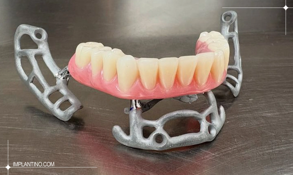 شکل ایمپلنت ساب پریوستئال