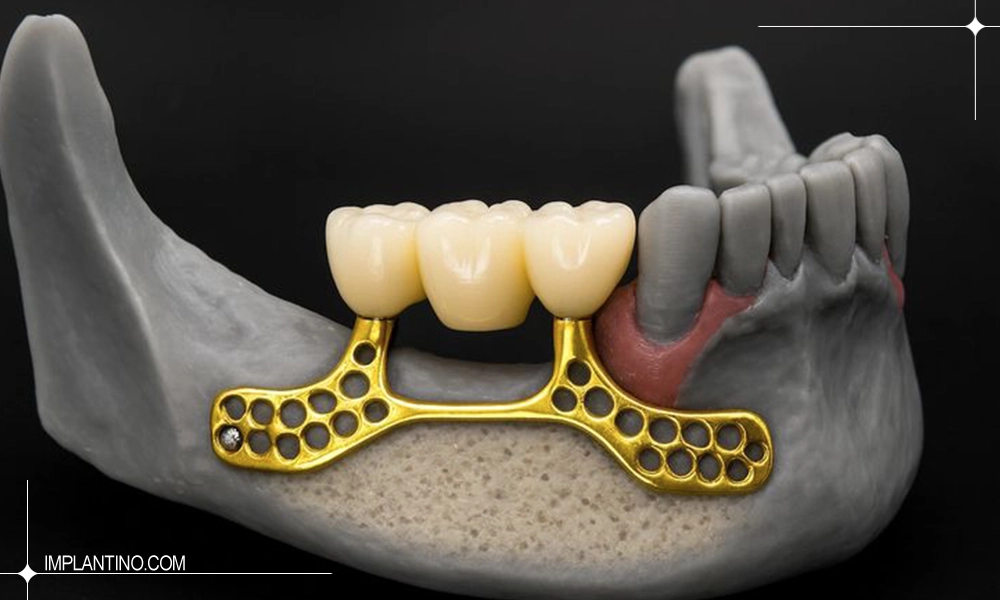 عکس ایمپلنت ساب پریوستئال