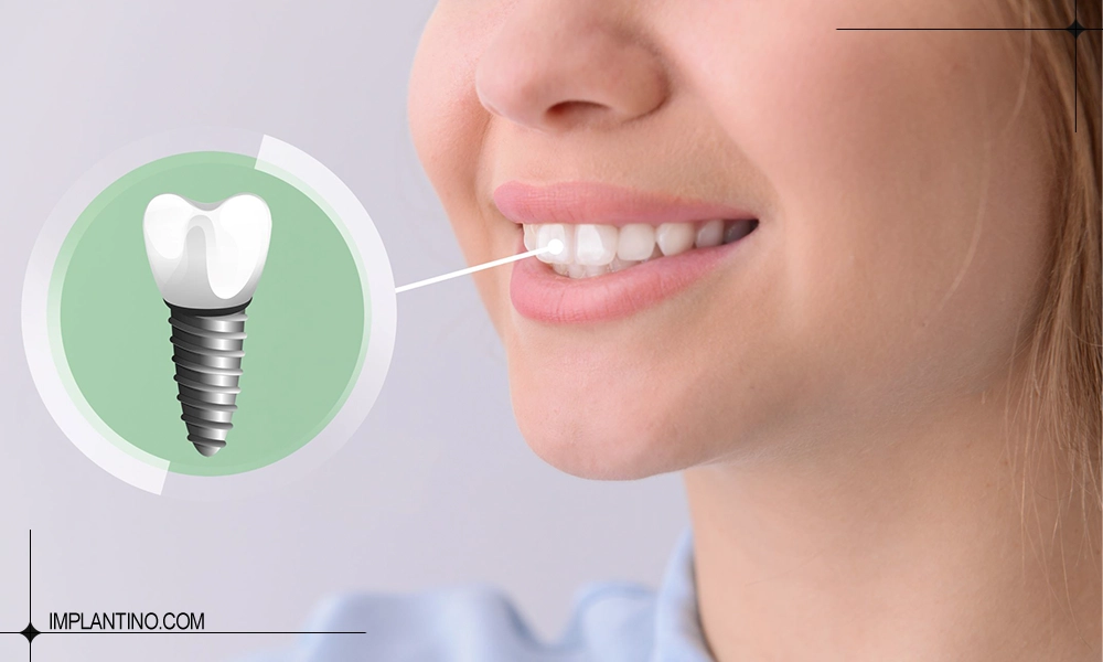 نصب ارزان ترین ایمپلنت برای دندان جلو