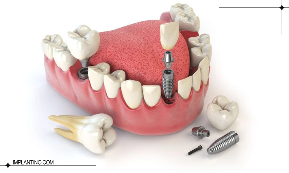 تعرفه قیمت ایمپلنت دندان