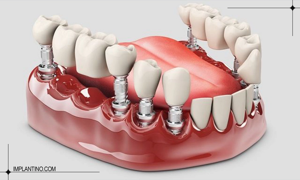 تعرفه قیمت ایمپلنت دندان