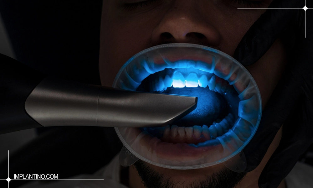 آشنایی با قالب گیری دندان 3 قالب گیری دیجیتال دندان