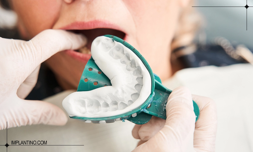 آشنایی با قالب گیری دندان 1 قالب گیری دندان