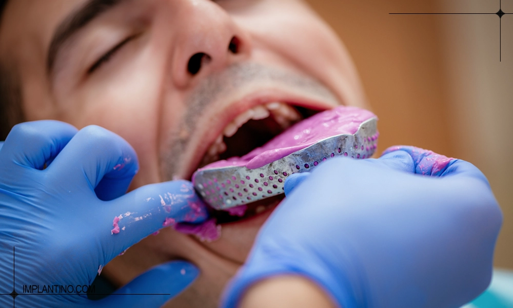 آشنایی با قالب گیری دندان 2 نحوه و مراحل قالب گیری دندان