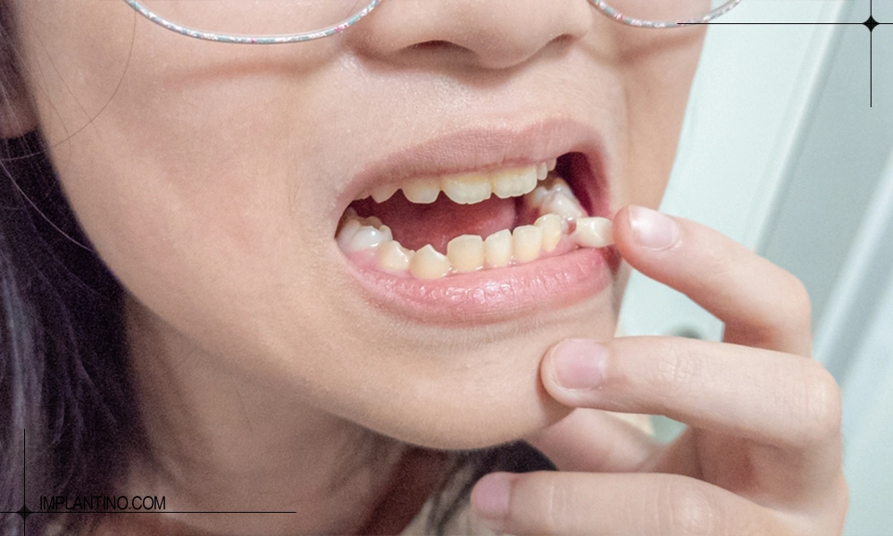 لق شدن دندان پایین یک خانم 