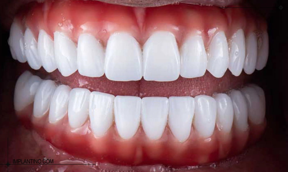 راه داشتن دندان صدفی