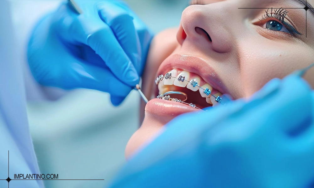 نکات مهم در مراقبت های بعد از ارتودنسی دندان