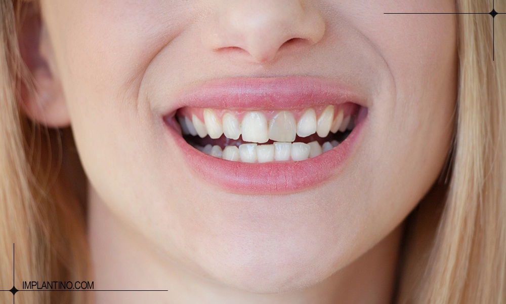 دلیل تغییر رنگ دندان بعد از عصب کشی 2 تغییر رنگ دندان بعد از عصب کشی دندان جلو